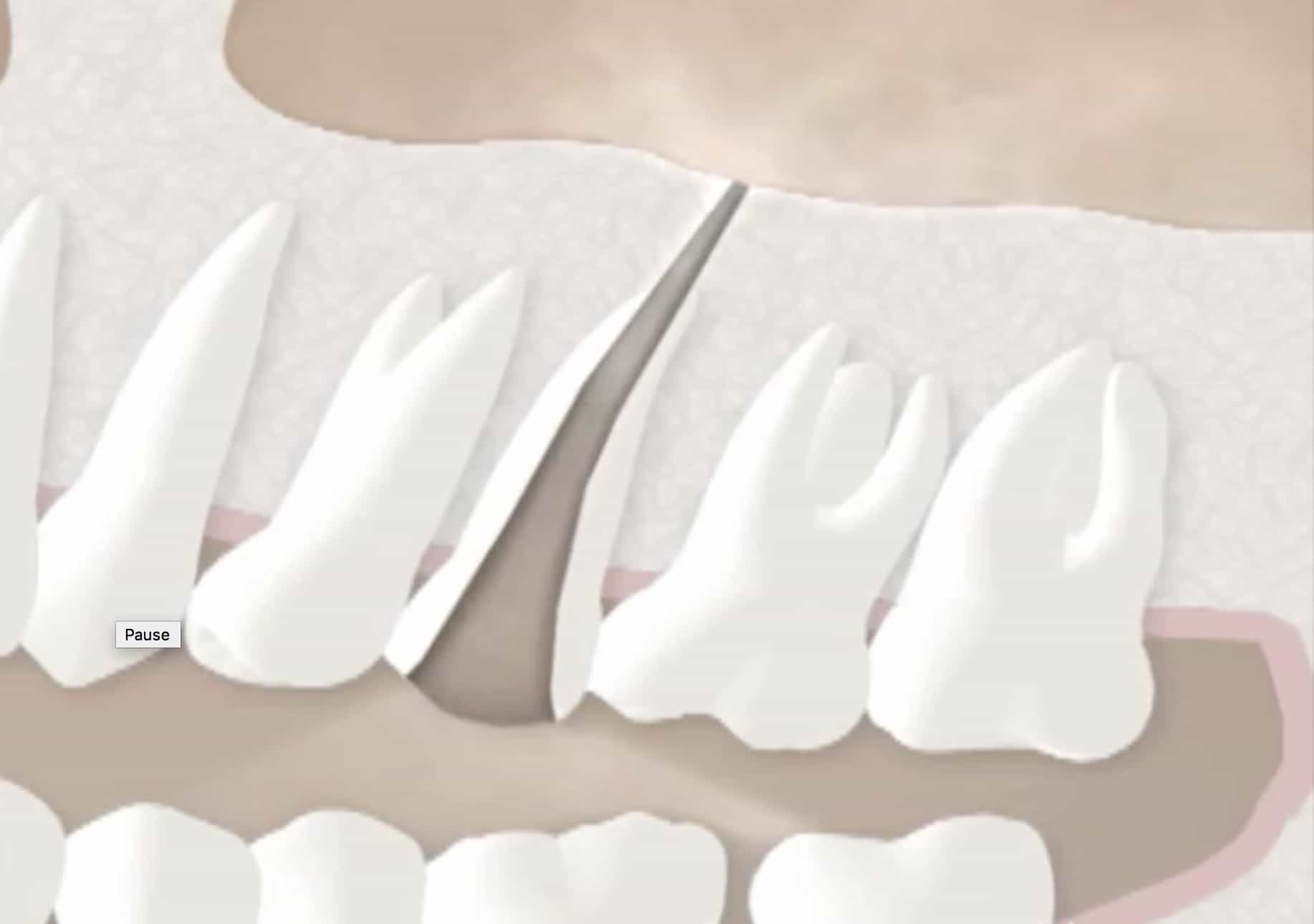 After Endodontic Treatment Woodside Endodontics Redwood City, CA